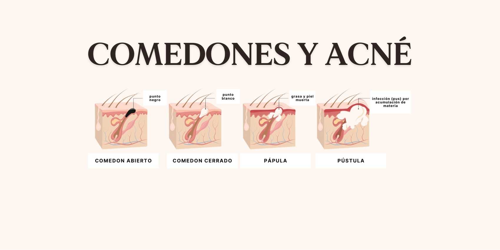 etapas de acne y comedones