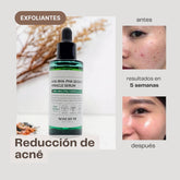 serum acne